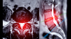 Back Pain Imaging and Exercise