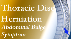 Apple Country Chiropractic cares for thoracic disc herniation that for some patients prompts abdominal pain.