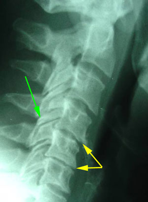 disc degeneration treated at Apple Country Chiropractic