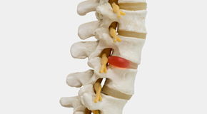 Williamson chiropractic conservative care helps even giant disc herniations go away