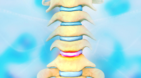 Williamson disc degeneration health