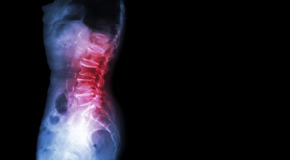 Williamson Chiropractic Care of Spondylolisthesis 