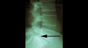 Williamson spondylolisthesis 