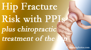 Apple Country Chiropractic shares new research describing higher risk of hip fracture with proton pump inhibitor use. 