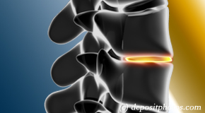 Williamson degenerative spinal changes 