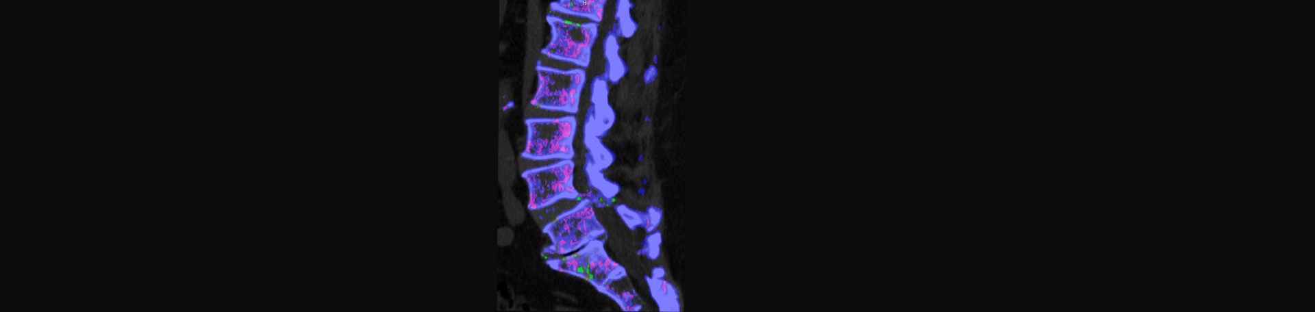 Apple Country Chiropractic is aware that inflammatory spinal gout is a differential diagnosis to consider for patients who present with back pain and other spine related symptoms.