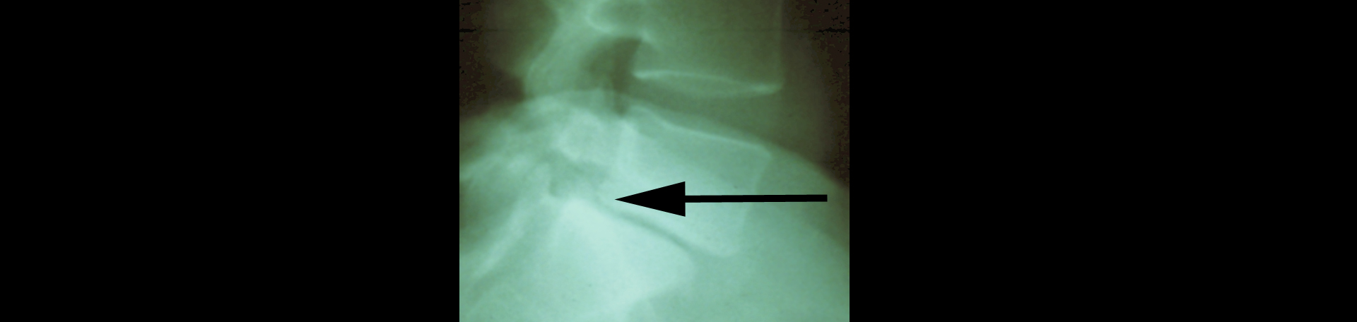 Williamson spondylolisthesis 