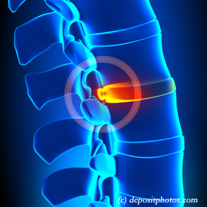 image of lumbar Williamson disc herniation